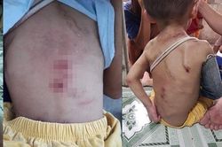 Hồi sức, điều trị cho bé trai 2 tuổi ở TPHCM nghi bị bạo hành