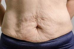 Cách làm săn chắc vùng da chảy xệ