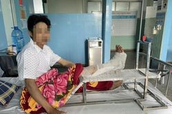 Nối liền bàn chân bị máy cắt cỏ cắt đứt gần lìa