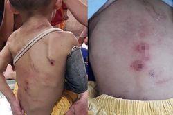 Bé 2 tuổi nghi bị cha mẹ bạo hành vẫn chưa được xuất viện