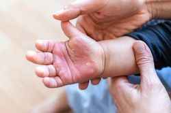 Bác sĩ hướng dẫn cách sơ cứu đúng khi trẻ bị bỏng