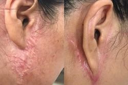 Căng da mặt bằng phẫu thuật có giúp trẻ vĩnh viễn không?