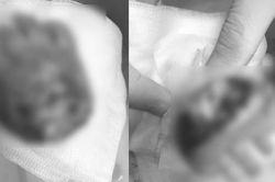 Máy dập nắp cốc nhựa cứa đứt lìa bàn tay bé trai