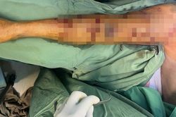 BR-VT: Cứu kịp thời bệnh nhân bị chó cắn gây đa vết thương khắp cơ thể