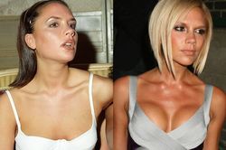Victoria Beckham và các sao nữ hối hận khi 'dao kéo'