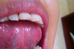 Lưỡi là 'thước đo' sức khỏe, thấy 4 dấu hiệu cảnh báo này thì đừng có chủ quan