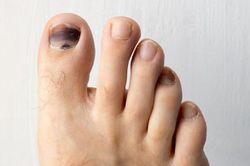 Móng chân đổi màu cảnh báo bệnh gì?