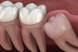 Răng mọc ngầm: Nguyên nhân, biểu hiện và điều trị