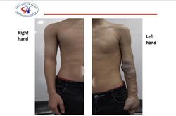 Thiếu niên 17 tuổi có cánh tay trái rỗ như tổ ong