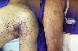 Người đàn ông ở Hà Nội tử vong sau vài ngày giết mổ lợn