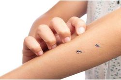 Nguyên nhân khiến bạn hay bị muỗi đốt hơn người khác
