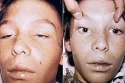 Từ vụ 3 bệnh nhi ngộ độc botulinum, có dấu hiệu này cần đưa đến bệnh viện ngay