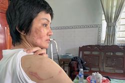 Người phụ nữ mang bầu 7 tháng bị chồng bạo hành dã man