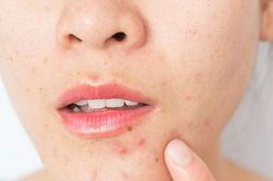 Nguyên nhân gây mụn dưới cằm và cách khắc phục