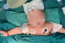 Phẫu thuật thành công nâng lún xương sọ não cho bệnh nhi 2,5 tháng tuổi