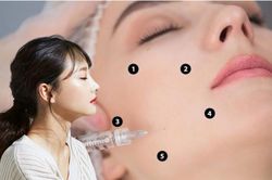 Tiêm BAP đang làm mưa làm gió mùa hè này: Chuyên gia chỉ rõ công dụng, mẹo tránh rủi ro khi làm