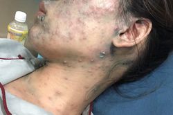 Thai phụ 22 tuần nhập viện cấp cứu do thủy đậu bội nhiễm