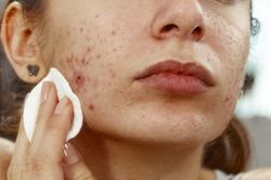 Cách chăm sóc da mụn trứng cá ngày hè