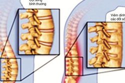 Viêm cột sống dính khớp, điều trị như thế nào?