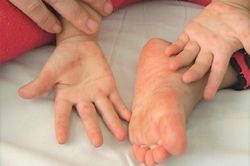 Bé trai 1 tuổi ở Đắk Lắk tử vong vì bệnh tay chân miệng