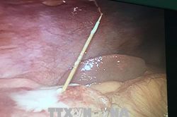 Nuốt phải tăm sau khi ăn, cô gái trẻ bị thủng ruột