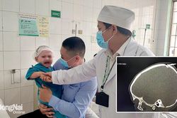 Đồng Nai: Cứu sống bé trai 2 tuổi bị đinh đâm qua xương sọ