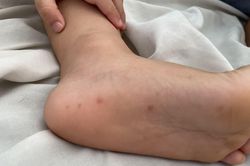 TP Hồ Chí Minh: Thành lập tổ chuyên gia khi bệnh tay chân miệng có biến chủng nguy hiểm
