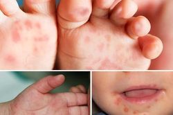 Đã có trẻ tử vong nghi mắc tay chân miệng: 6 khuyến cáo của Bộ Y tế phòng chống bệnh cần biết