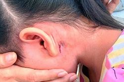 Bị bệnh vi khuẩn ăn thịt người 'tấn công', bé 2 tuổi tử vong