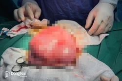 Phẫu thuật lấy khối u xơ tử cung to như trái bóng đá, nặng gần 3kg