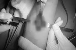 Cô bé 14 tuổi được phát hiện ung thư ác tính từ dấu hiệu lạ ở tay