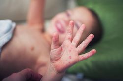 Bộ Y tế: Sắp có thuốc điều trị các ca tay chân miệng nặng