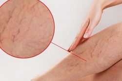 Ứng phó với suy giãn tĩnh mạch bằng các biện pháp tại nhà