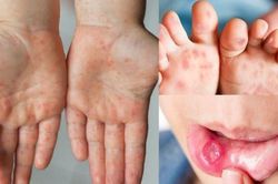 Gần 9.000 ca tay chân miệng, 3 ca tử vong, Bộ Y tế yêu cầu tăng cường phòng chống