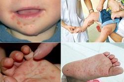 Chuyên gia hướng dẫn phòng tránh bệnh tay - chân - miệng ở trẻ