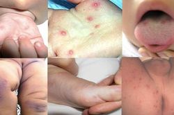 Cảnh báo dịch chồng dịch – tay chân miệng và sốt xuất huyết