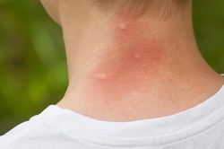 Mùa hè cảnh giác với sẩn ngứa do côn trùng