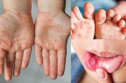 TP HCM chỉ đạo 'khẩn' phòng bệnh tay chân miệng