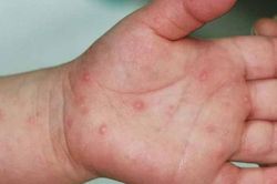 Mẹ tự điều trị tay chân miệng cho con suýt gây hậu quả nghiêm trọng