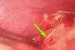 Áp lực thi cử, nam sinh nhập viện trong tình trạng bụng co cứng như khúc gỗ