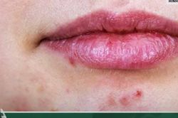 'Bắt bệnh' từ vị trí mọc mụn