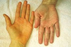 Dấu hiệu cơ thể cảnh báo bệnh gan, nên đi khám càng sớm càng tốt