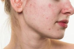 Ghi sổ một vài công thức giúp giải quyết tình trạng da vừa khô vừa bị mụn