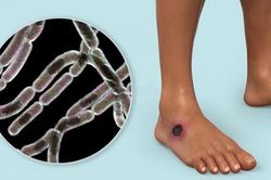 Trước nguy cơ lây lan dịch bệnh than trên người, Cục Thú y đưa ra khuyến cáo