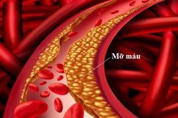 Không thể coi thường mỡ máu cao