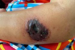 Nguy cơ lây lan bệnh than từ gia súc: Bác sĩ chỉ cách phòng tránh