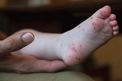 Trẻ bị tay chân miệng nên kiêng và ăn gì?