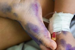 Dấu hiệu dễ bị bỏ sót khi trẻ mắc tay chân miệng