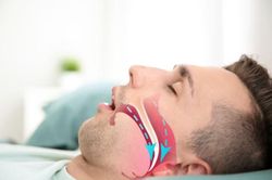 Ngủ chảy nước miếng là dấu hiệu của bệnh gì?