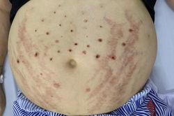 Người đàn ông ở Hà Nội nhập viện do để ong châm chữa bệnh